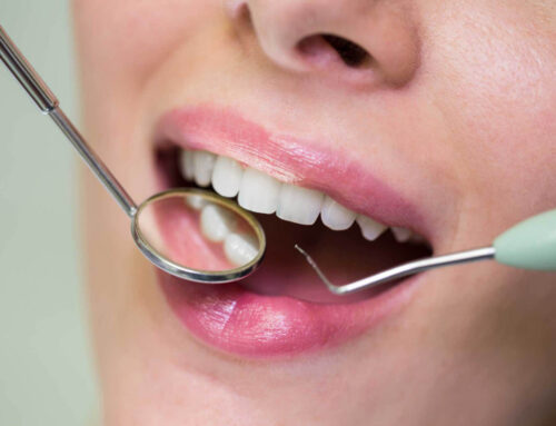 Pulizia dei denti, cos’è ed a cosa serve